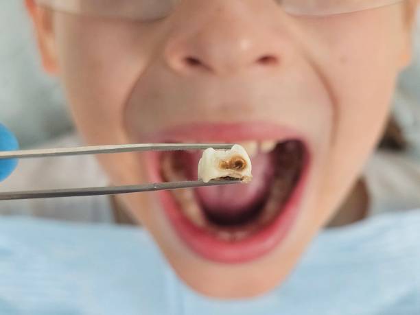 Best Emergency Broken Tooth Repair in Nemacolin, PA